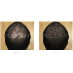 Foligain Plaukų augimą skatinanti priemonė vyrams Advanced Hair Regrowth For Men Minoxidil 5% + Trioxidil 5%