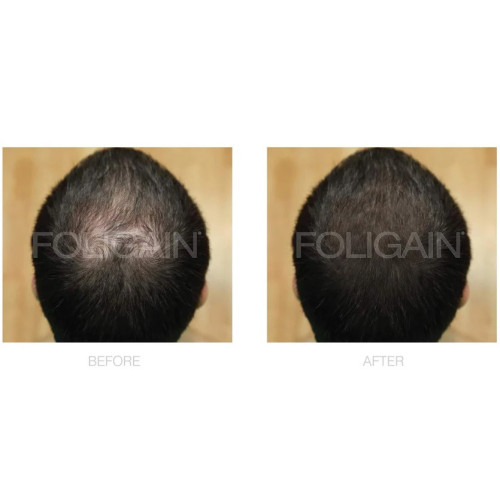 Foligain Plaukų augimą skatinanti priemonė vyrams Advanced Hair Regrowth For Men Minoxidil 5% + Trioxidil 5%