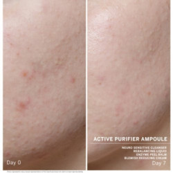 Babor Giliai valančios ampulės veidui probleminei odai Ampoule Concentrate Active Purifier