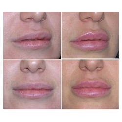 Putlinamoji lūpų priemonė su hialiuronu, peptidais ir moringos aliejumi Dr. Brandt Needles no more™ 3-D Lip Plump Fix 25g