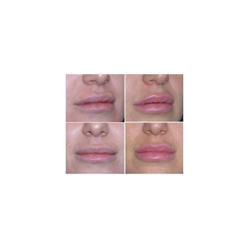 Putlinamoji lūpų priemonė su hialiuronu, peptidais ir moringos aliejumi Dr. Brandt Needles no more™ 3-D Lip Plump Fix 25g